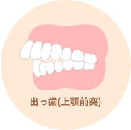 出っ歯(上顎前突)